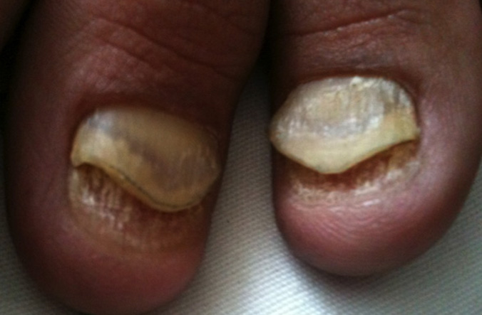 Dr Ajmal Rashid Dermatologist - Trachyonychia • Trachyonychia means rough  surface of nails • All 20 nails may be effected • This condition is mainly  associated with: - a. Alopecia aerate b.
