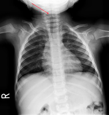 Steeple sign (trachea), Radiology Reference Article