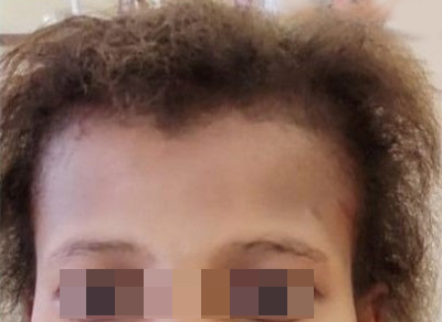 A case of woolly hair nevus associated with pigmentary demarcation lines  and heterochromia iridis Coincidence or a new association